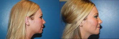 Chin Filler before and after photo