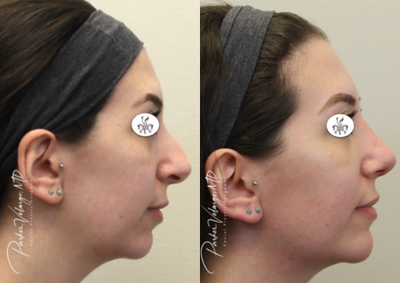 Chin Implant before and after photo