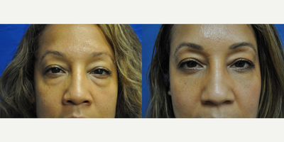 Eyelid Surgery before and after photo