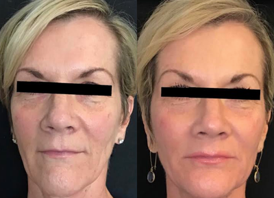 Laser Resurfacing before and after photo