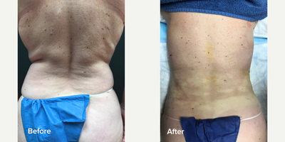 Renuvion before and after photo