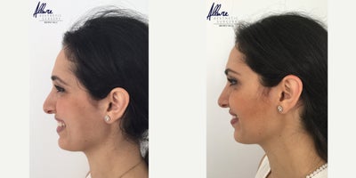 Botox before and after photo