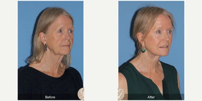 CO2 Laser before and after photo