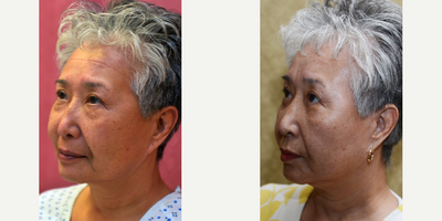 Eyelid Surgery before and after photo