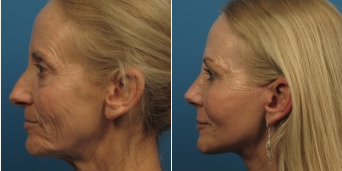 Rhinoplasty before and after photo