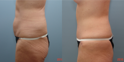 Tummy Tuck before and after photo