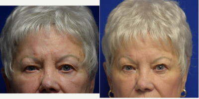 Brow Lift before and after photo