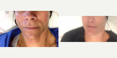 Chemical Peel before and after photo