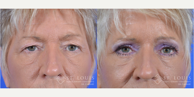 Eyelid Surgery before and after photo