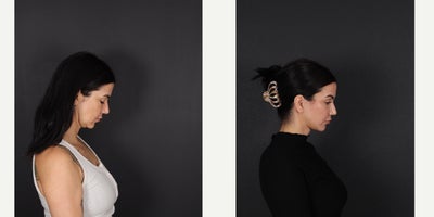 Eyelid Surgery before and after photo