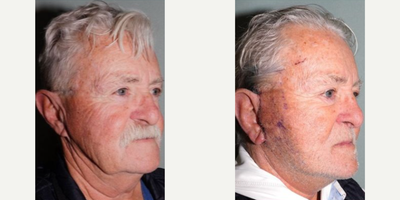 Facelift before and after photo