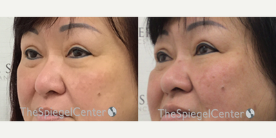 AccuTite before and after photo