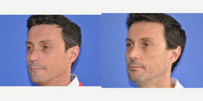 Botox before and after photo