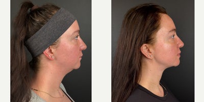 before and after image