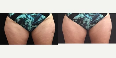 CoolSculpting before and after photo
