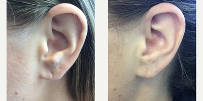 Earlobe Repair before and after photo