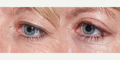 Eyelid Surgery before and after photo