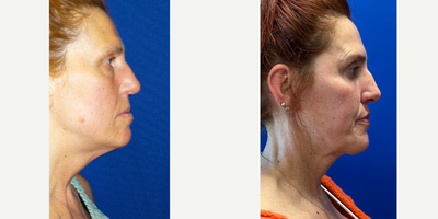 Eyelid Surgery before and after photo