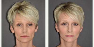 Facelift before and after photo