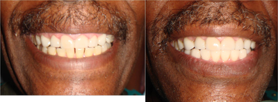 Porcelain Veneers before and after photo