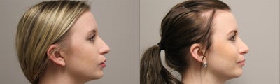 Rhinoplasty before and after photo