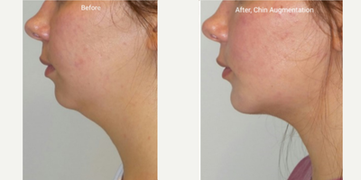 Chin Implant before and after photo