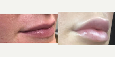 Dermal Fillers before and after photo