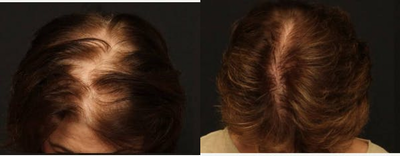 NeoGraft before and after photo