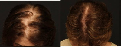 NeoGraft before and after photo