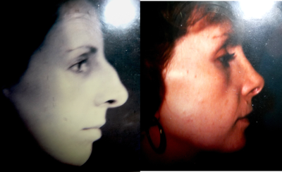 Rhinoplasty before and after photo
