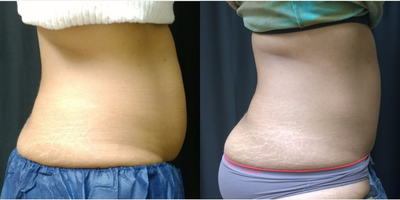 CoolSculpting before and after photo