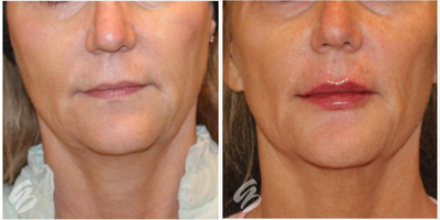Dermal Fillers before and after photo