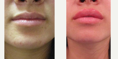 Lip Fillers before and after photo