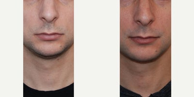 Chin Liposuction before and after photo