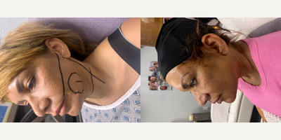 FaceTite before and after photo