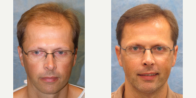 FUE Hair Transplant before and after photo