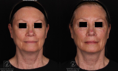 Juvederm before and after photo