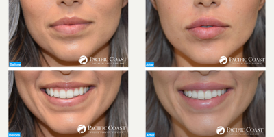 Lip Fillers before and after photo