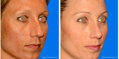Rhinoplasty before and after photo