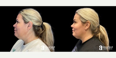 Chemical Peel before and after photo