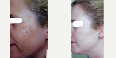 Laser Resurfacing before and after photo