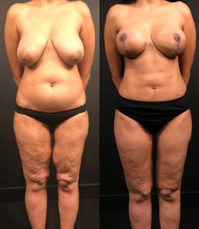Mommy Makeover before and after photo