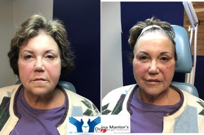 Nonsurgical Facelift before and after photo