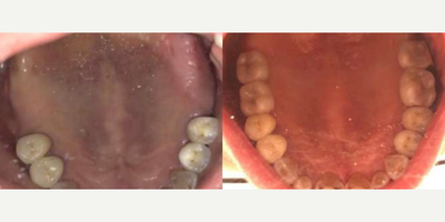 Dental Implants before and after photo