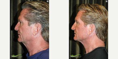 Facelift before and after photo