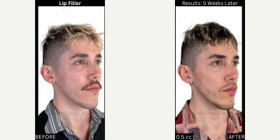 Lip Fillers before and after photo