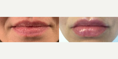 Lip Lift before and after photo