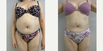 Liposuction before and after photo