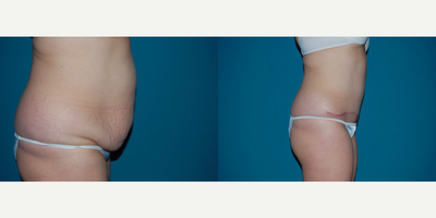 Tummy Tuck before and after photo