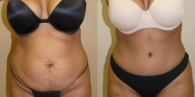Tummy Tuck before and after photo